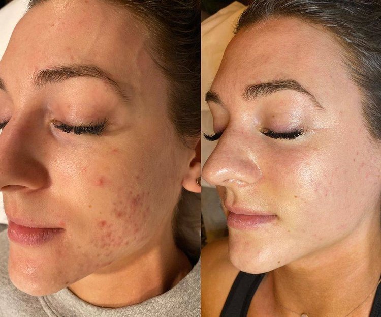 Acne Treatment for Face