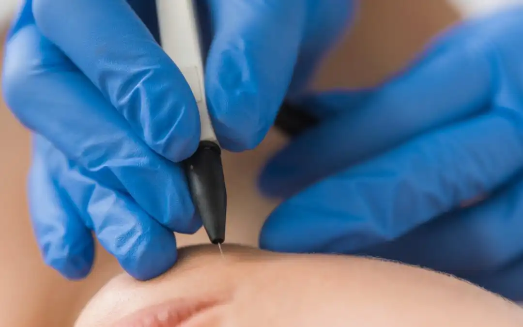 Unveiling the Permanence: The Benefits of Electrolysis for Hair Removal