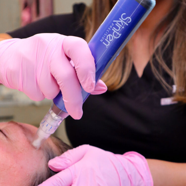 Skinpen Microneedling Device performing treatment