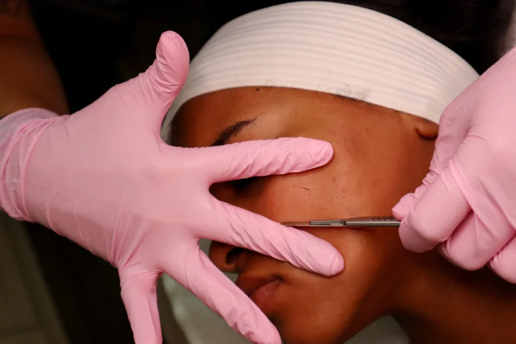 Unveiling Beauty Skin After Dermaplaning