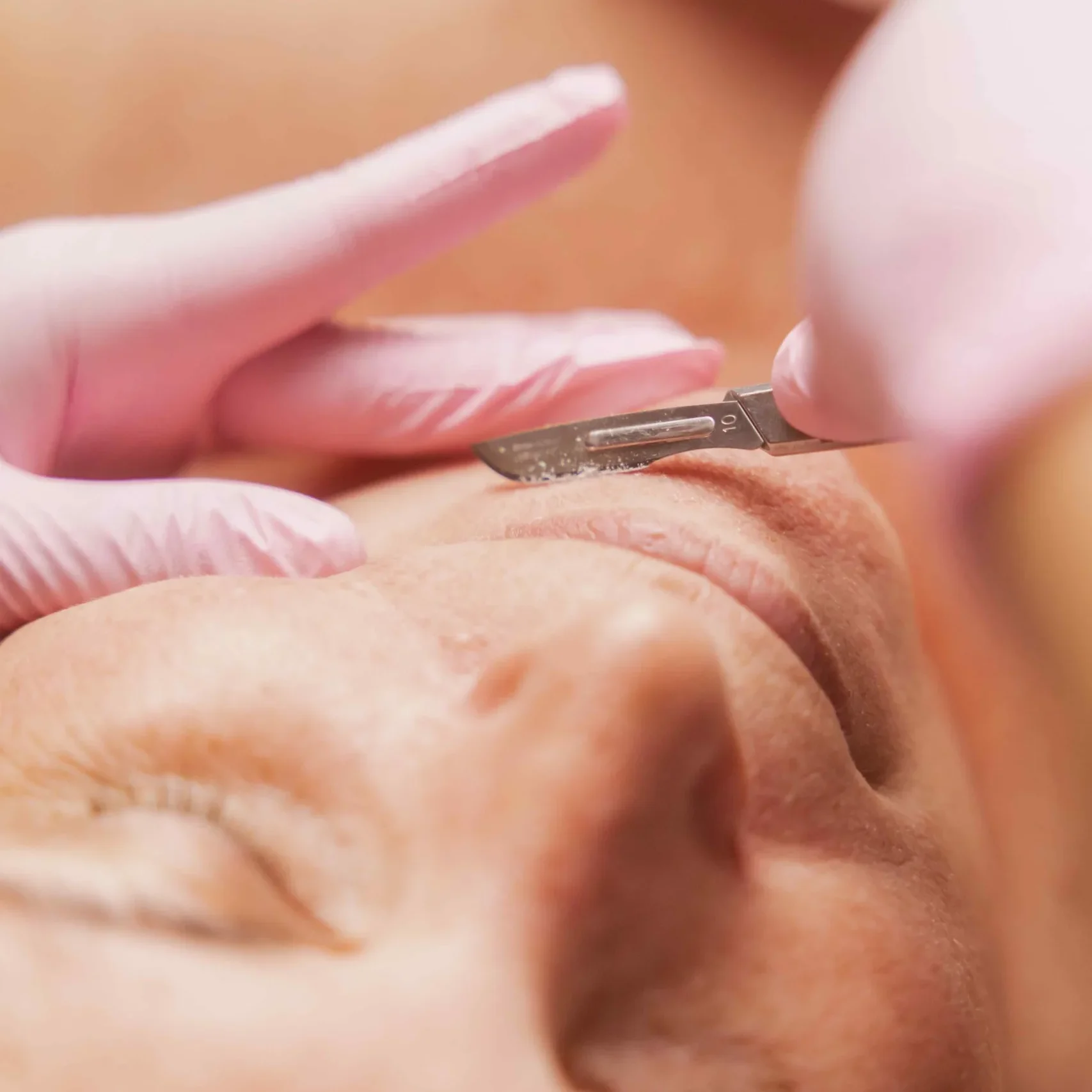 Dermaplaning Unveiling Beauty Skin After Dermaplaning