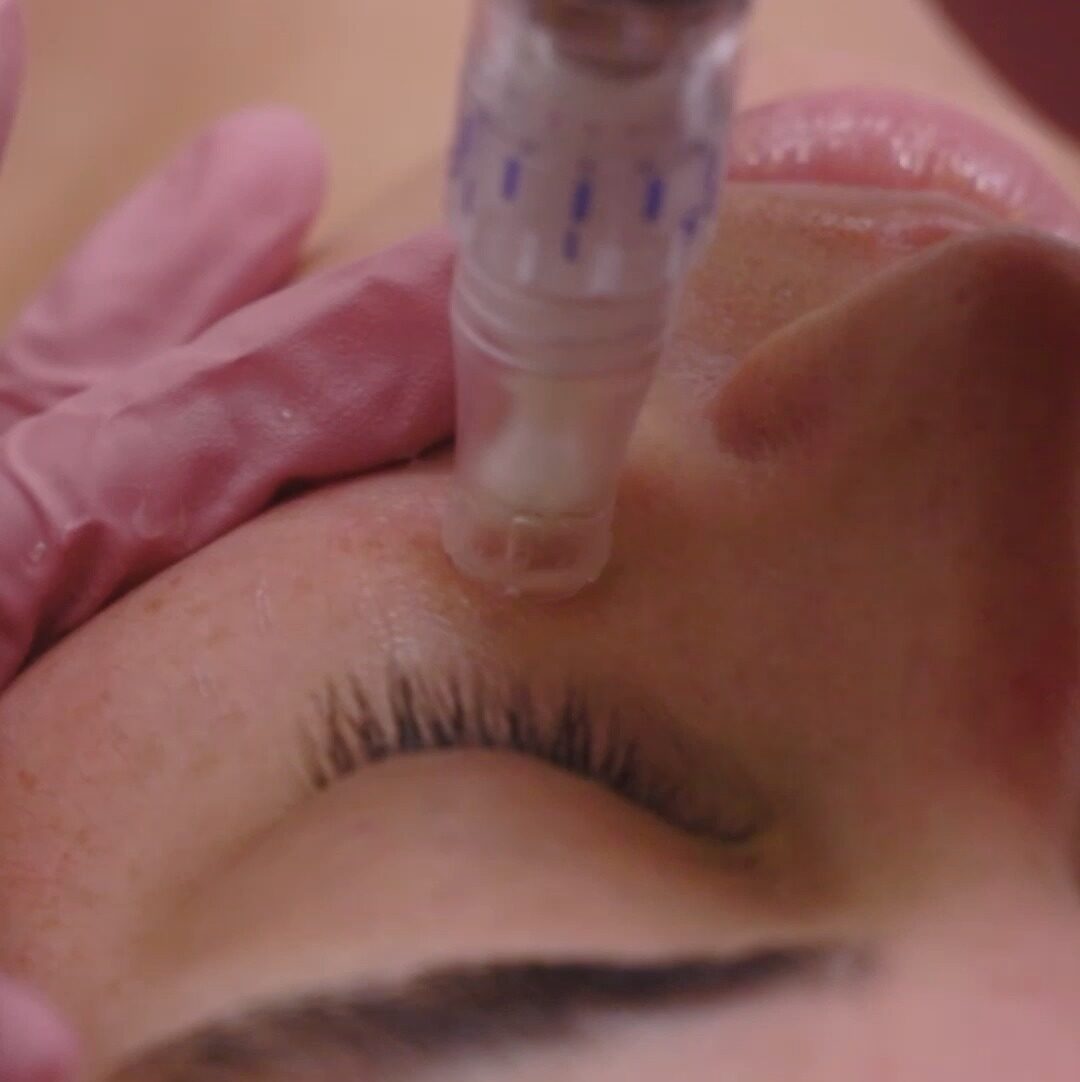 Microneedling-2-0 Microneedling 2 0 e1746926493762