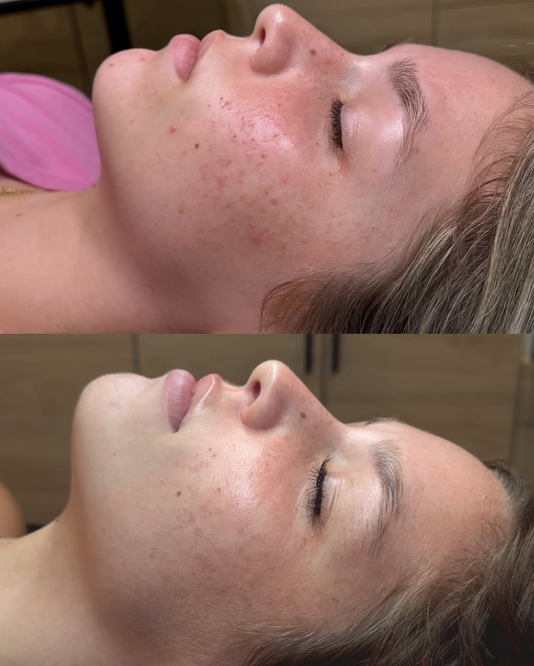 Acne Treatments 02