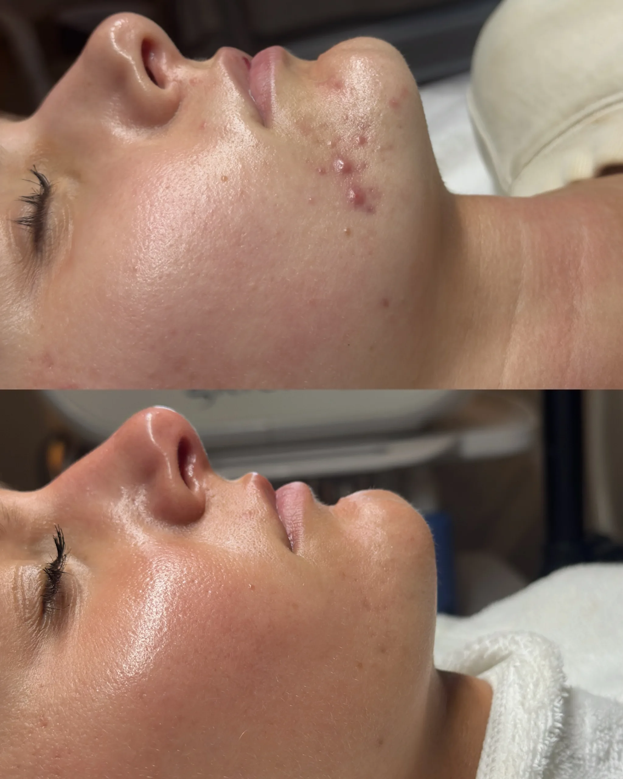 Acne Facials 18 C0357BF9 52C0 40C8 9E5C D3EAC658C558 scaled