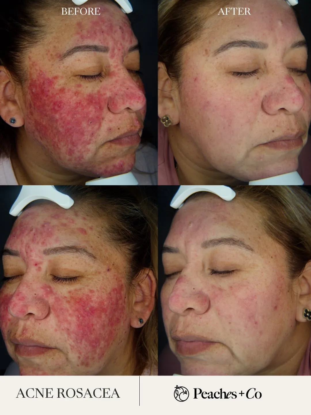 Acne Facials 1 SnapInsta.to 635505052 18400241188198953 4198140076751919315 n