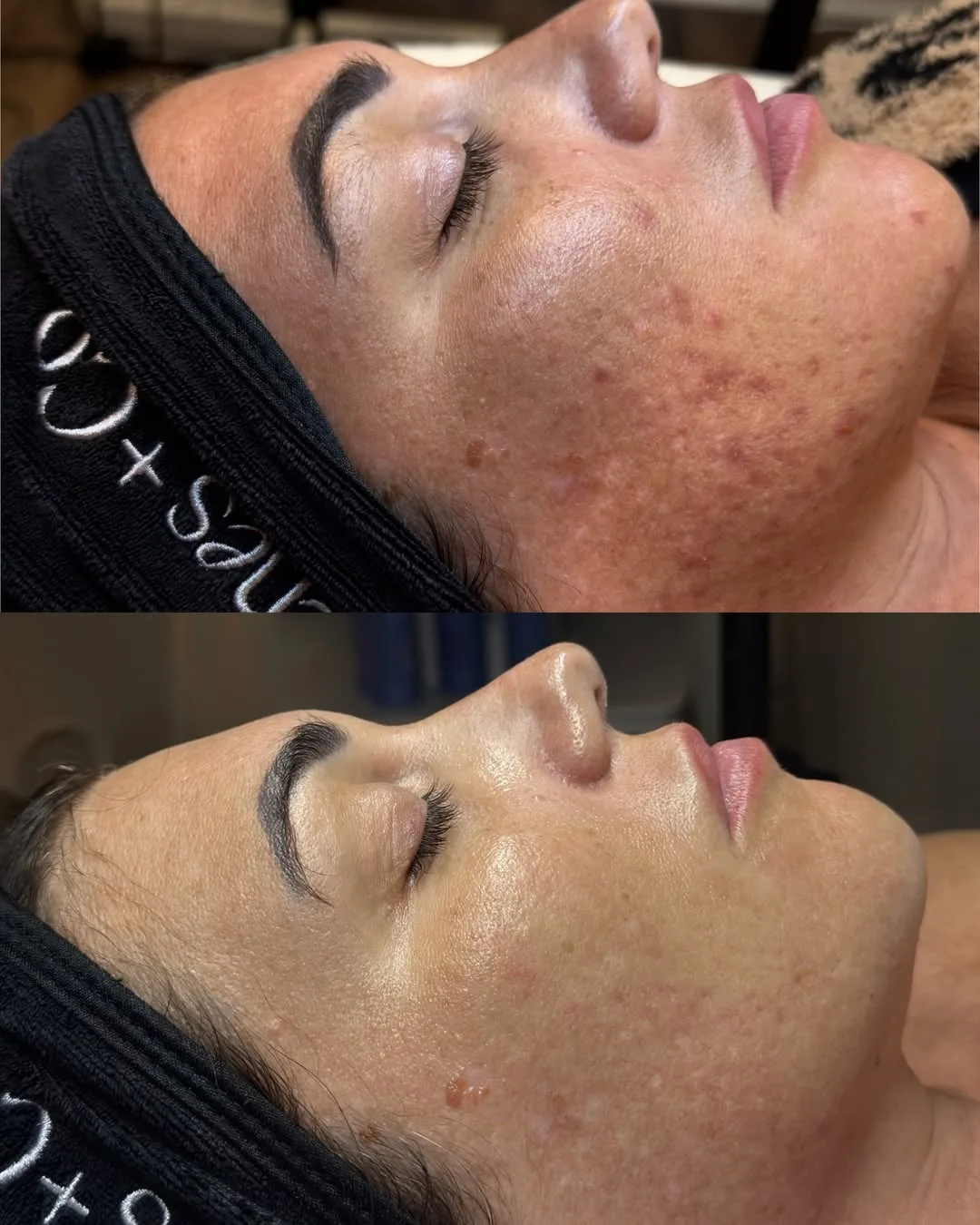 Acne Facials 4 SnapInsta.to 654737860 18405089077198953 765460158876812756 n