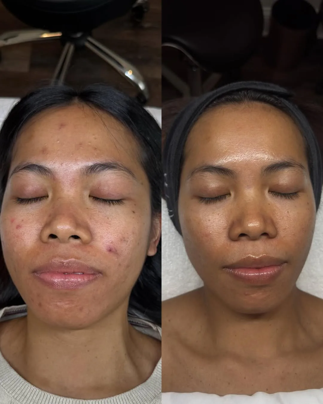 Acne Facials 5 SnapInsta.to 657861454 18408163462198953 5404905896120097765 n