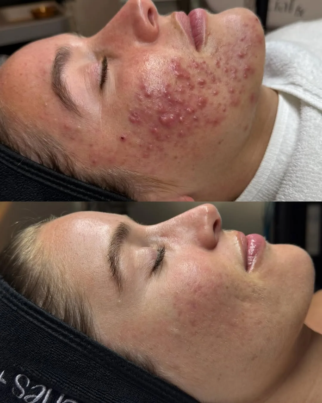 Acne Facials 3 SnapInsta.to 658876110 18407817379198953 536612338973787440 n