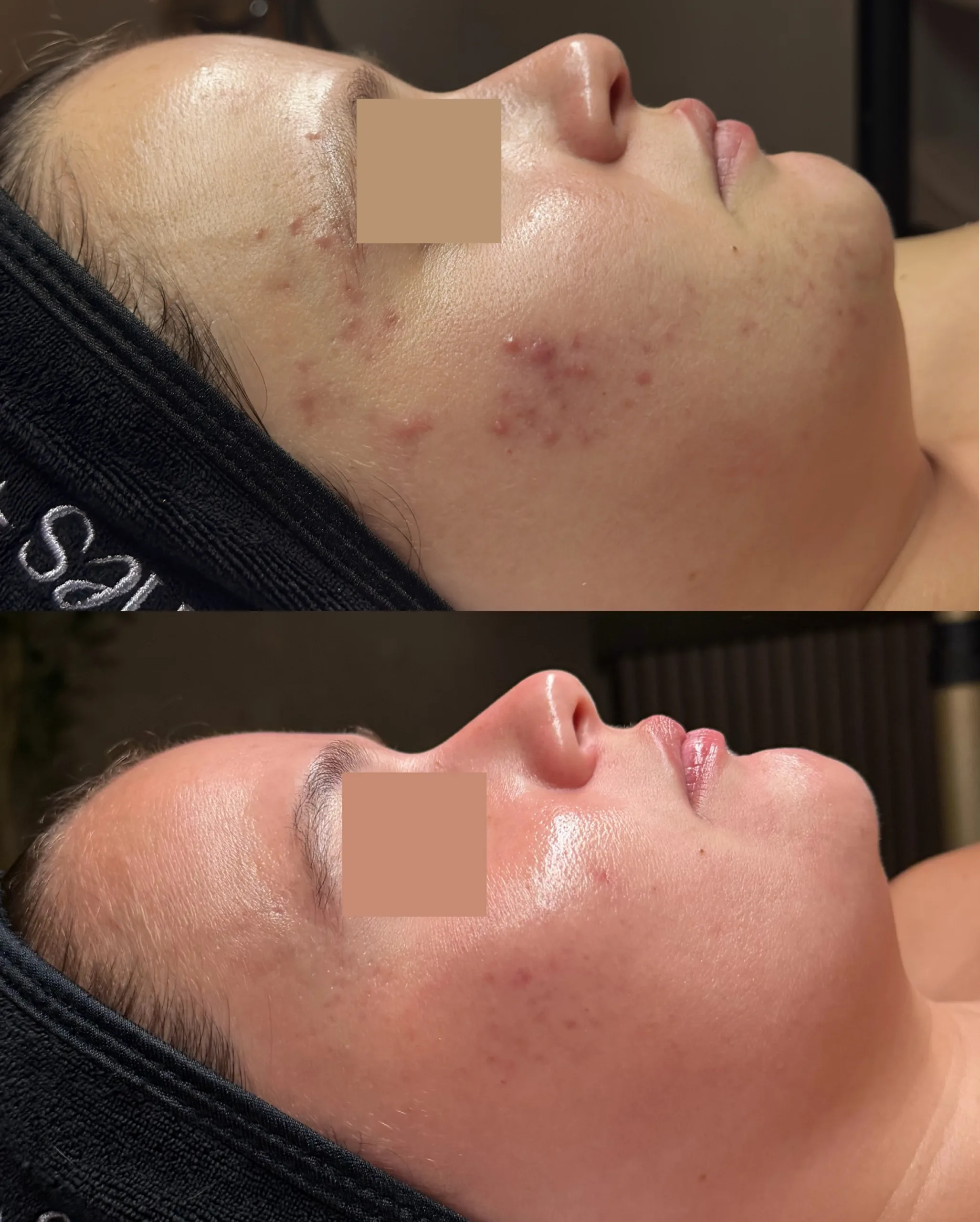 Acne Treatments 1 Acne Treatment Results scaled