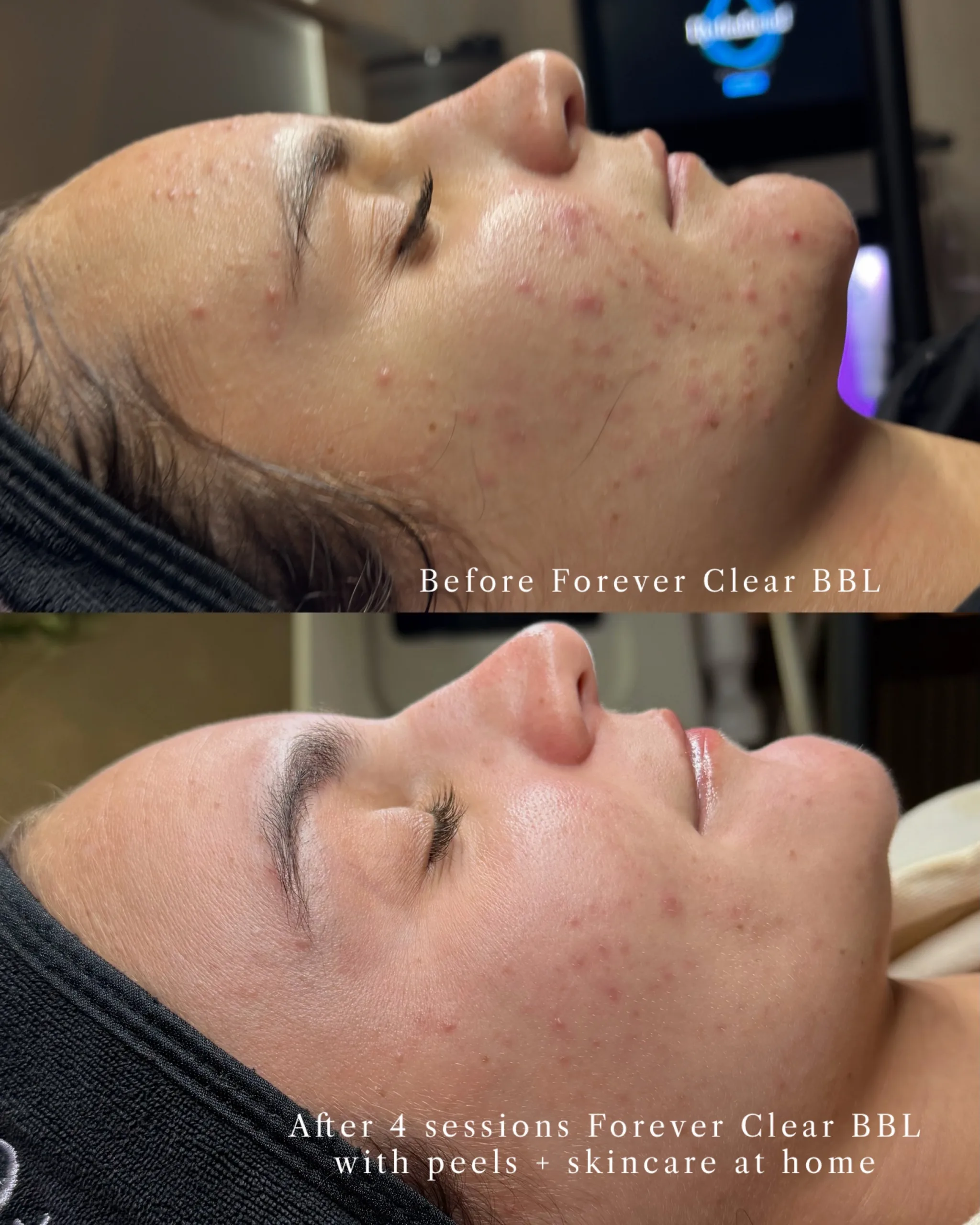 Acne Treatments 7 Acne Treatment results 2 scaled