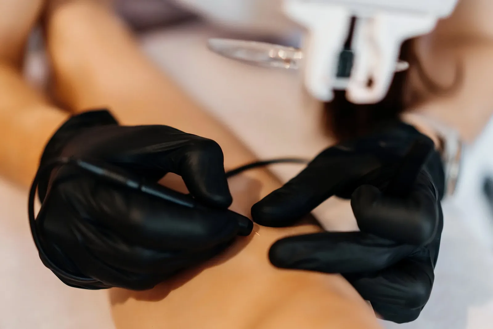 Electrolysis Hair Removal