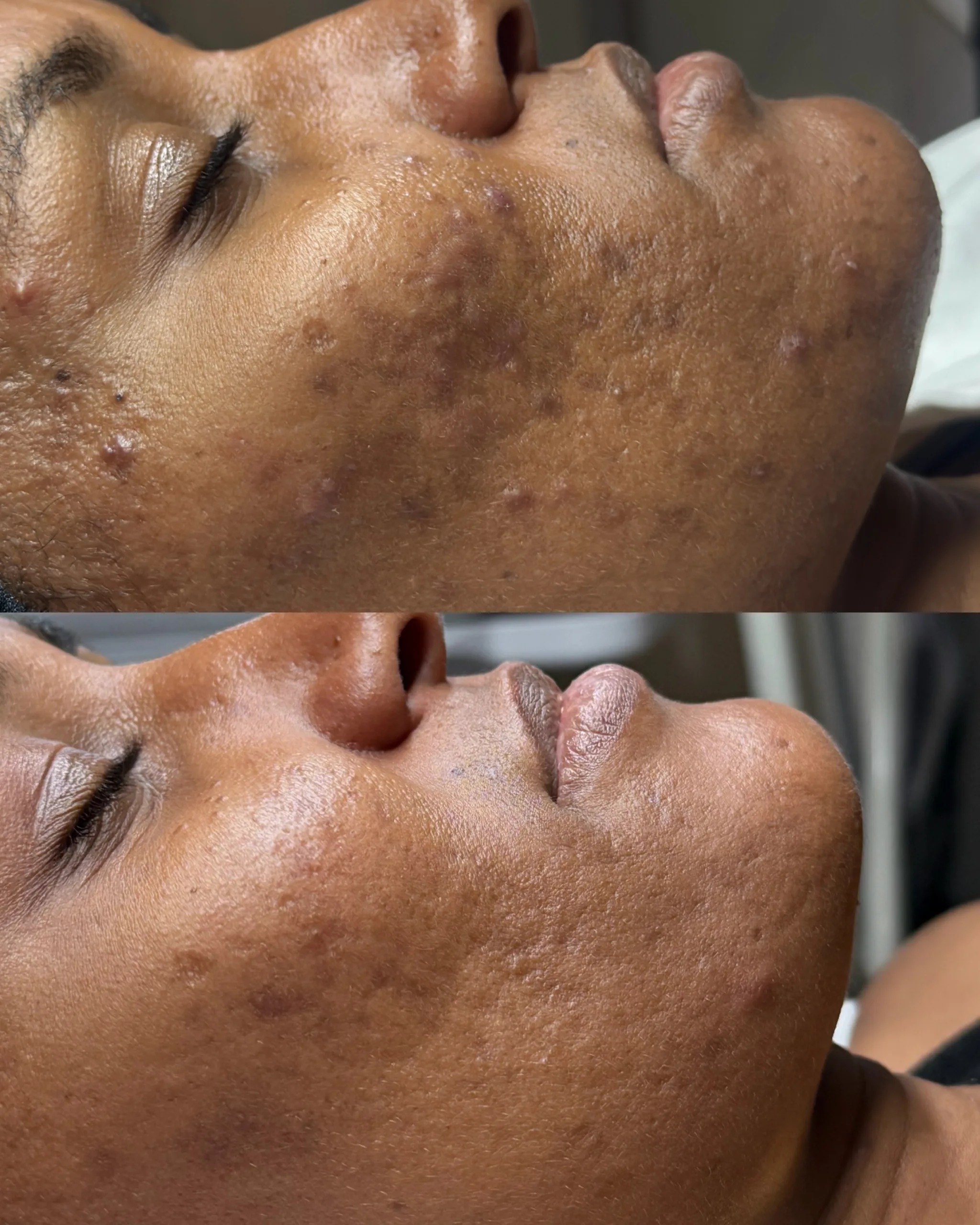 Acne Treatments 4 SnapInsta.to 741693683 18423783280198953 8825423387283925288 n scaled