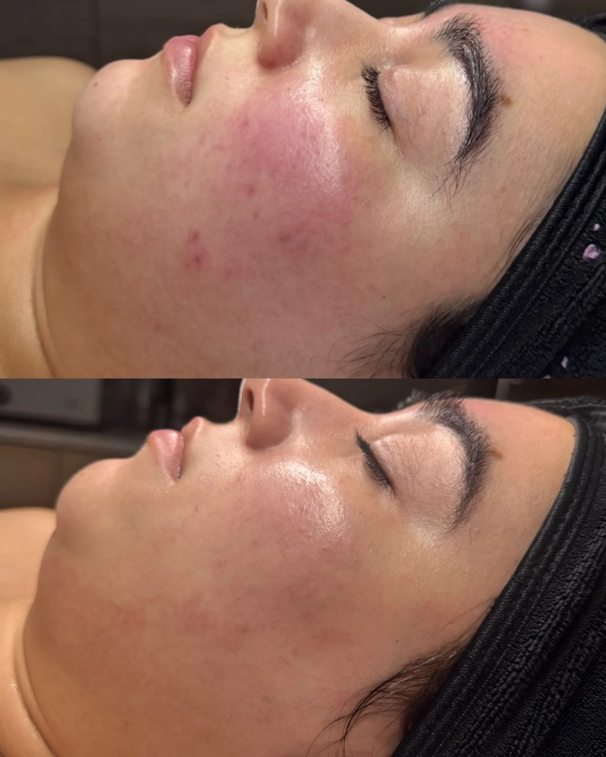 Acne Treatments 5 SnapInsta.to 761125326 17928696993365926 3712611682149093098 n scaled