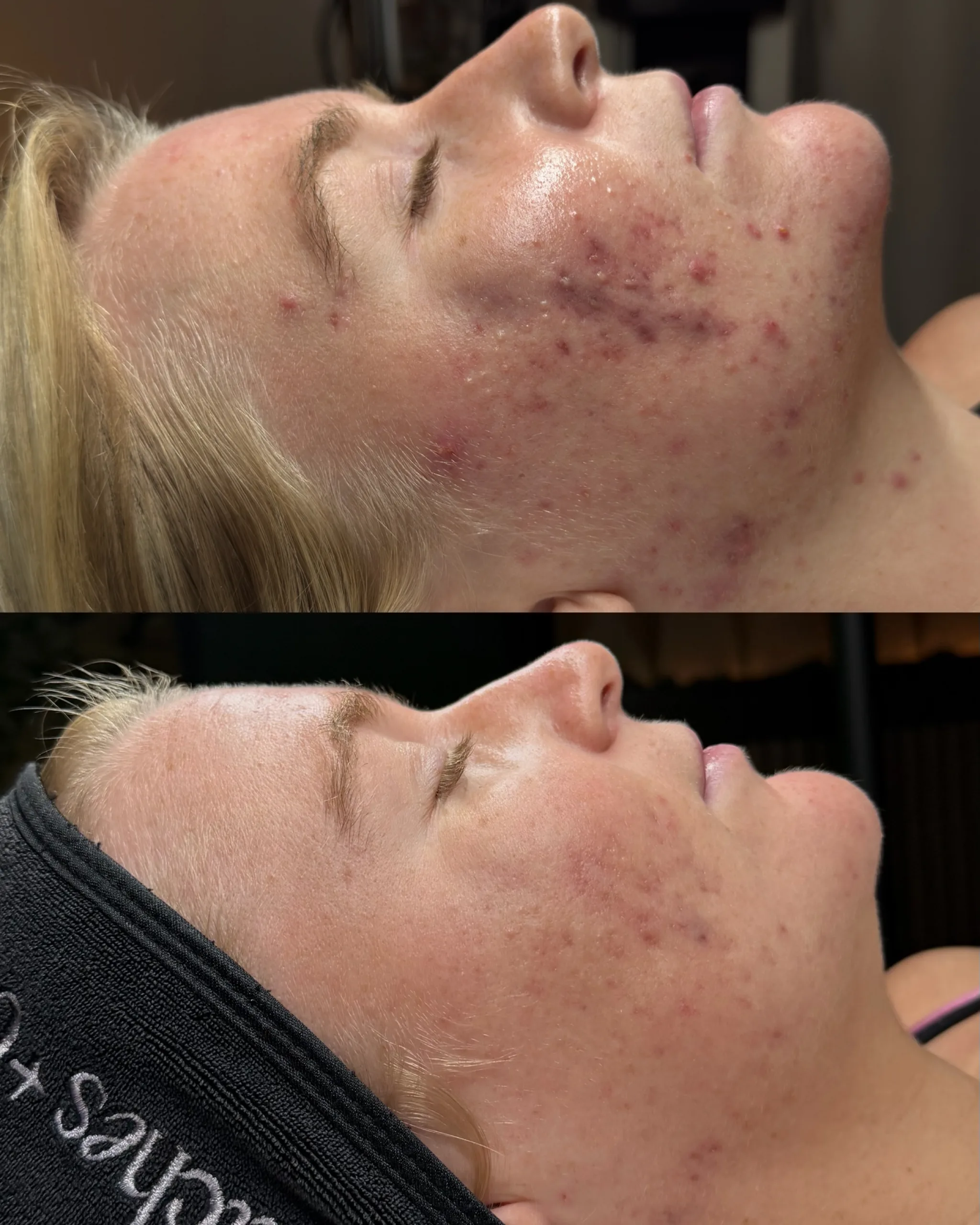Acne Treatments 6 SnapInsta.to 790002329 18100833494618542 4679689949804566938 n scaled