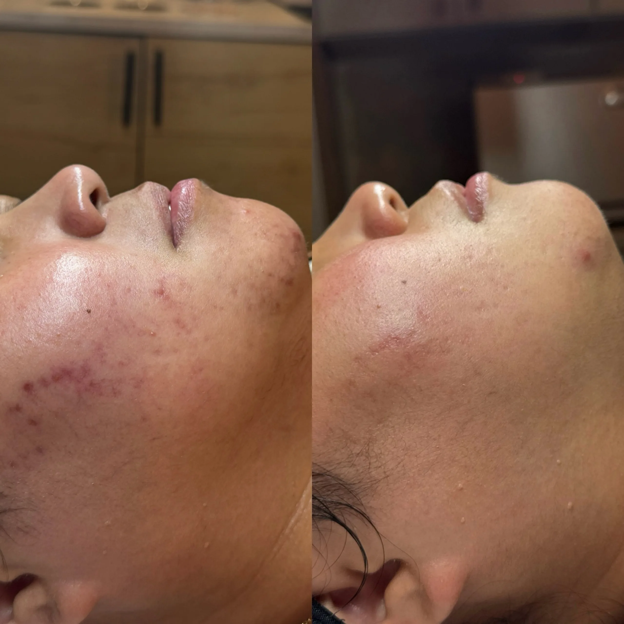Acne Treatments 3 SnapInsta.to 790669122 17934096255365926 7197930796119572577 n scaled