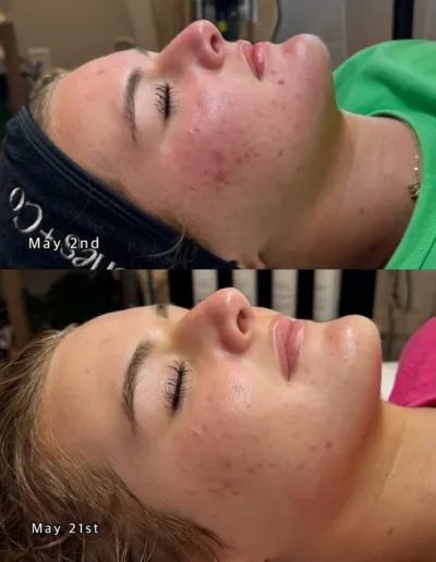 Acne progress photos from May 2nd and May 21st showing calmer, clearer skin
