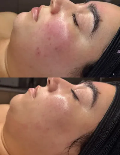 Before and after acne care showing calmer, less red skin on a client's cheek