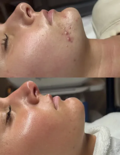 Before and after acne treatment showing cleared breakouts along a client's chin