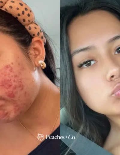 Before and after acne treatment, from inflamed cheek breakouts to clear, smooth skin