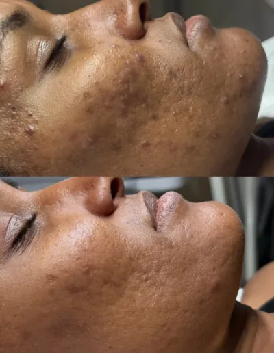 Before and after acne treatment on a client with deeper skin, showing fewer breakouts