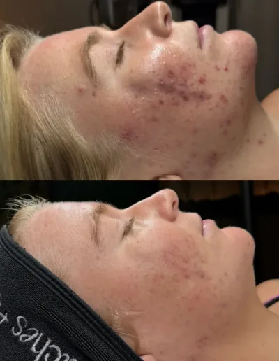 Before and after acne treatment showing inflamed cheek breakouts calmed and cleared