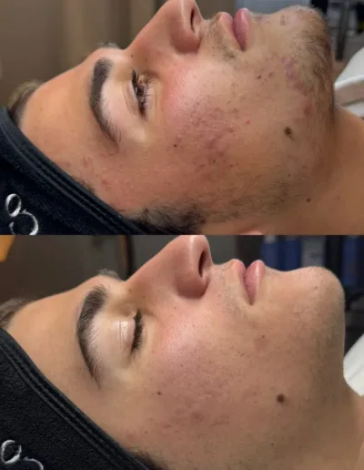 Before and after acne treatment on a male client's cheek and jawline