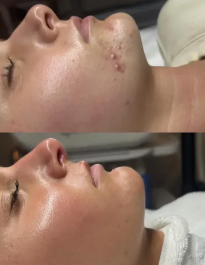 Before and after acne treatment showing cleared breakouts and a smooth, glowing cheek