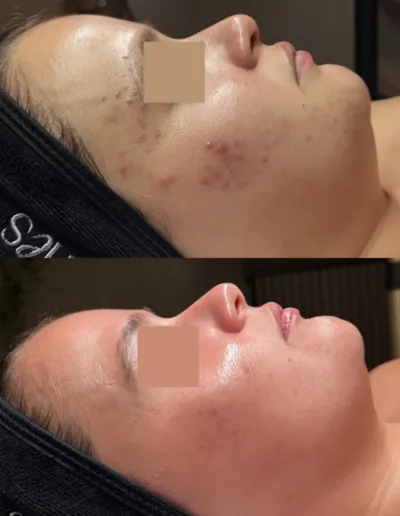 Before and after acne treatment showing clearer skin along a client's cheek and jaw