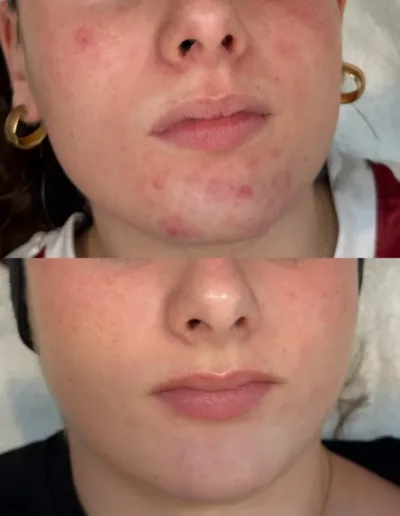 Before and after acne treatment showing clearer skin around a client's chin and mouth