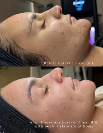 Acne before and after four Forever Clear BBL sessions with peels and home skincare