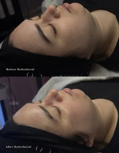 Before and after HydraFacial showing smoother, more radiant skin on a client's profile