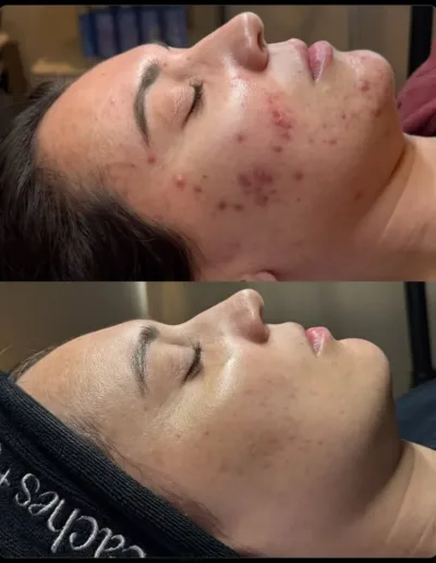 Before and after acne treatment showing inflamed cheek acne calmed and cleared