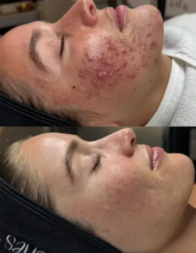 Before and after acne treatment showing severe cheek breakouts significantly cleared